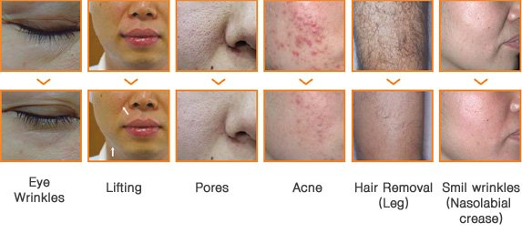 ipl + rf hair removal instrument,ipl & rf beauty device,home ipl skin rejuvenation